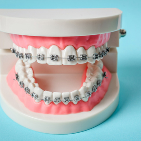 Toy teeth with traditional braces and light blue background