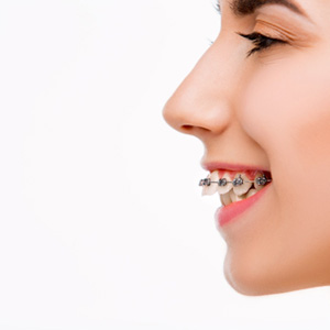 Profile view of woman’s face to show protruding overbite with braces