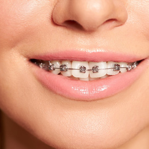 Nose-to-chin closeup of woman smiling with braces on crooked teeth
