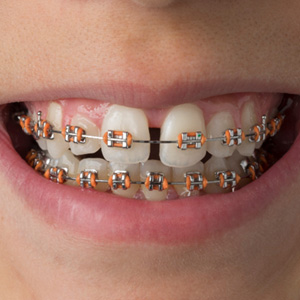 Closeup of someone’s diastema being treated with braces with orange bands